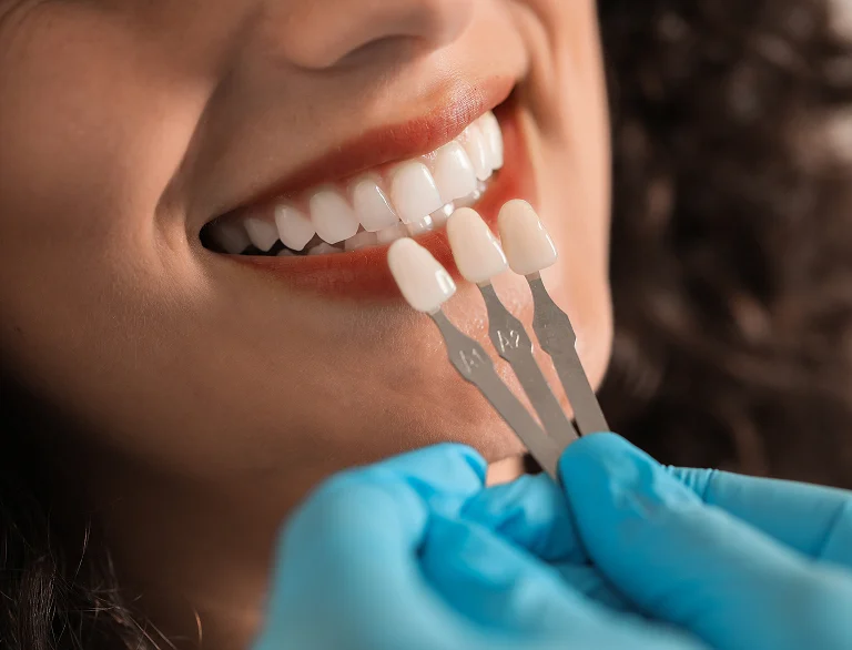 Transforming Smiles with Dental Veneers