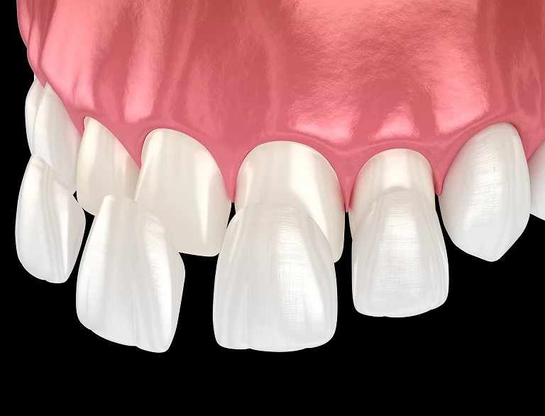 Why Choose Dental Veneers